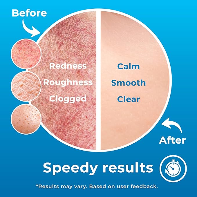 Hypochlorous Acid Spray (8oz, Reduces Acne), Targets Bacteria - HOCL Facial Cleanser Acne Spray for Face, Body, Eczema, Pimples, Breakouts & Overall Skin Recovery (Reduces Redness)-Velvo Beauty