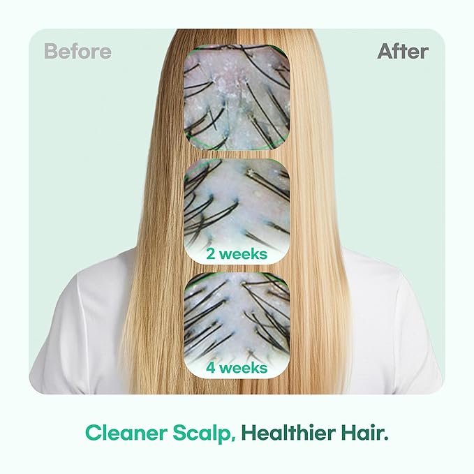 TS GD Shampoo for Teens | Korean Anti-Dandruff Shampoo for Oily & Itchy Scalp | Fruity Allergy-Free Scent | Sulfate-Free Gentle Hair Care (14.1 Oz)-Velvo Beauty
