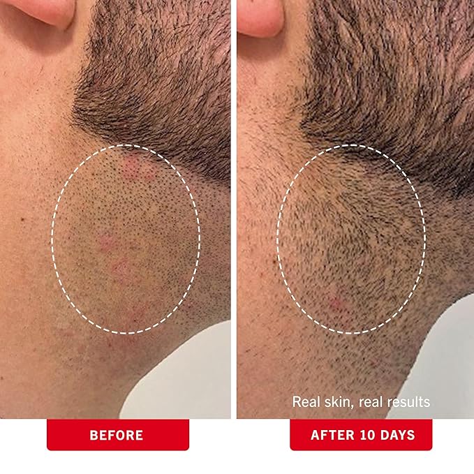 First Aid Beauty - Ingrown Hair Pads with BHA + AHA - Aftershave Treatment Pads Help Men & Women Prevent Razor Bumps, Exfoliate Underarms & Bikini Area, Compostable for Daily Use - 3ct, 84 Pads Total-Velvo Beauty