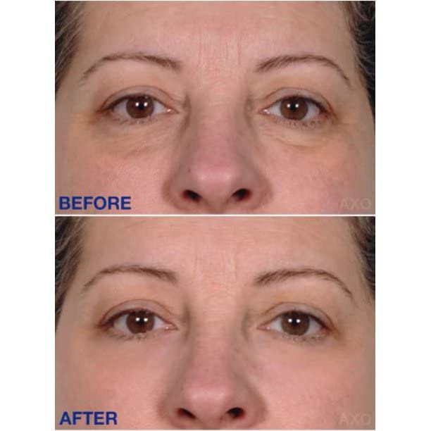 Age-Defying Under-Eye Serum | Best Instant Wrinkle Remover | Advanced Formula Anti Aging Visibly Reduces Under Eye Wrinkles, Bags, Dark Circles, Fine Lines & Crow’s Feet | 100% All-Natural-Velvo Beauty