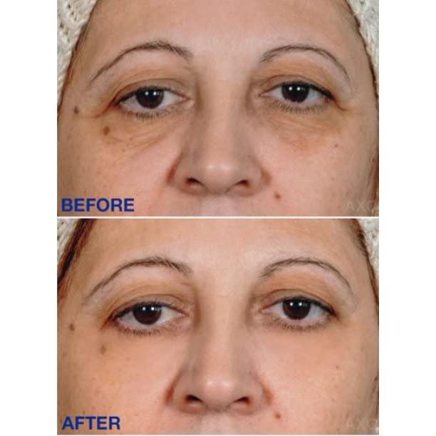 Age-Defying Under-Eye Serum | Best Instant Wrinkle Remover | Advanced Formula Anti Aging Visibly Reduces Under Eye Wrinkles, Bags, Dark Circles, Fine Lines & Crow’s Feet | 100% All-Natural-Velvo Beauty