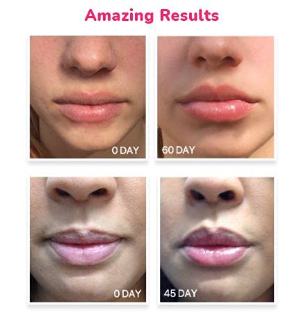 LifeCell Lip Plumping Treatment-Velvo Beauty