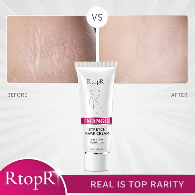 RtopR Mango Stretch Mark Cream for Pregnancy, Stretch Mark Repair Cream, Fade Line, Moisturizing and Non-Greasy, Safe to Use When Pregnant-Velvo Beauty