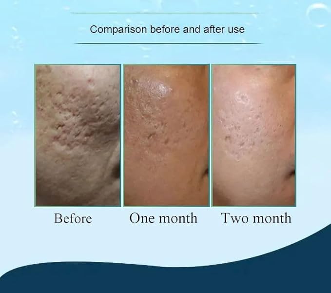 Hydra Needle 20 Titanium Serum Applicator Tools Reusable-Velvo Beauty