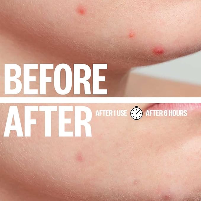 a.l.m. Magical Patch (2) Hydrocolloid pimple patches. These ultra thin & translucent hydrocolloid adhesive covers and absorb unwanted pimples. Parches Para Acne for skincare.-Velvo Beauty