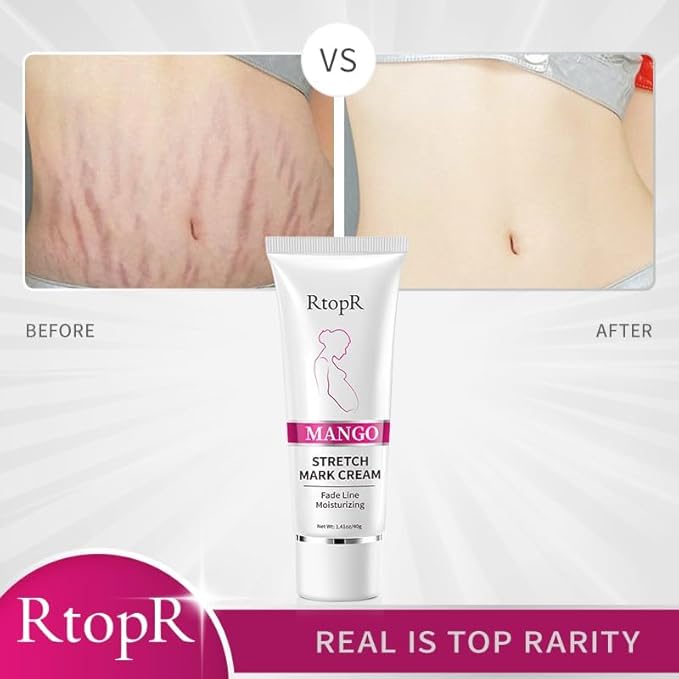 Stretch Mark Removal Cream, Obesity Stretch Mark Moisturizer, Postpartum Repair Stretch Mark Cream, Abdominal Stretch Mark Cream, Remove Marks (1 PCS)-Velvo Beauty