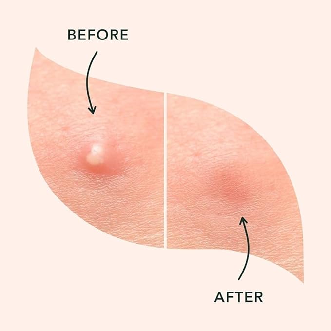 a.l.m. Magical Patch (2) Hydrocolloid pimple patches. These ultra thin & translucent hydrocolloid adhesive covers and absorb unwanted pimples. Parches Para Acne for skincare.-Velvo Beauty