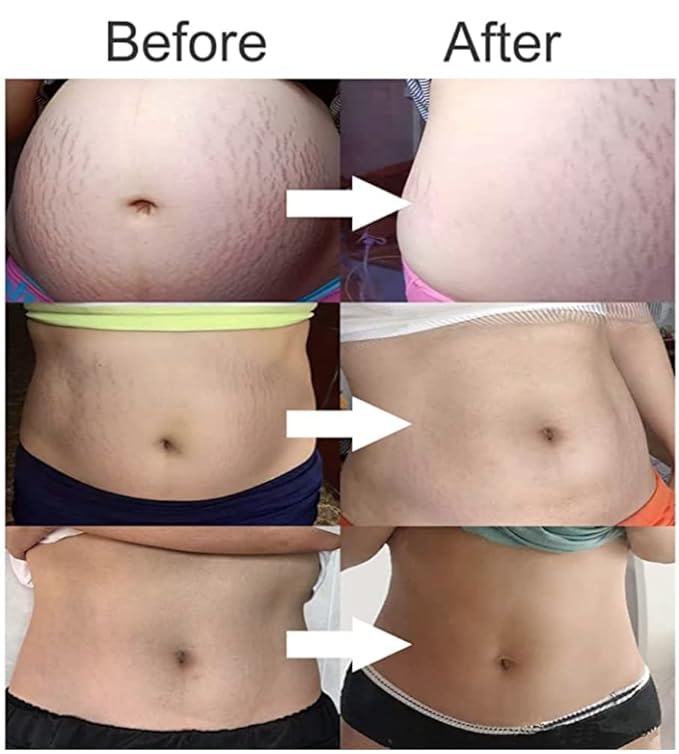 Stretch Mark Cream 120g/4 oz Stretch Marks Lotion Pregnancy Creams, Belly Butter Pregnant Women Stretch Mark Removal Treatment, Maternity Skin Care Moisturizer Scar Wrinkle Prevention-Velvo Beauty