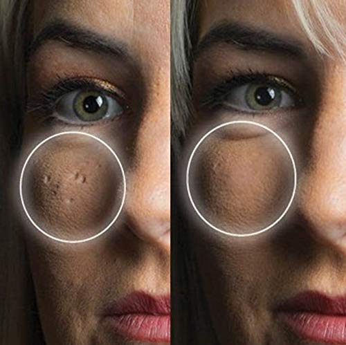 Dermaflage Scar Filler Kit - Medium - Deep Scar Cover and Waterproof Concealer for Acne Scars Wrinkles, and Ice Pick Scars Makeup, 1 mo supply-Velvo Beauty