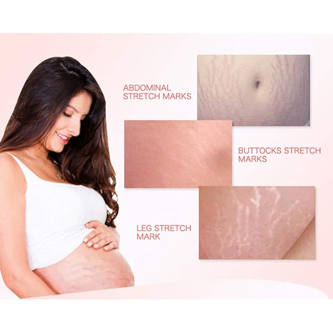AICHUN BEAUTY Pregnancy Cream Streach Mark Remover Scars Repair Cellulites Lotion Cream 150ml-Velvo Beauty