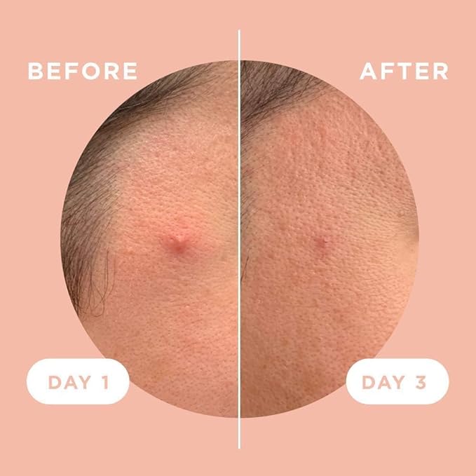 ZitSticka Killa Pimple Patches for Face - World's Most Potent Pimple Patch with Fast-Acting Microdarts - Starts Working within 6 Hours for Deep, Early-Stage Zits - Regular 12 Count with Cleana Swab-Velvo Beauty