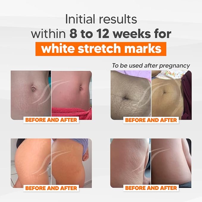 Cicatrissim Deep Stretch Mark Removal Cream - Innovative Formula With Pure and Powerful Natural Ingredients From Brazilian Flora - For All Stretch Marks & Skin Types.-Velvo Beauty