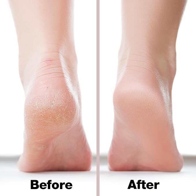 Probelle Double Sided Multidirectional Nickel Foot File Callus Remover - Immediately Reduces calluses and Corns to Powder for Instant Results, Safe Tool (Pink)-Velvo Beauty