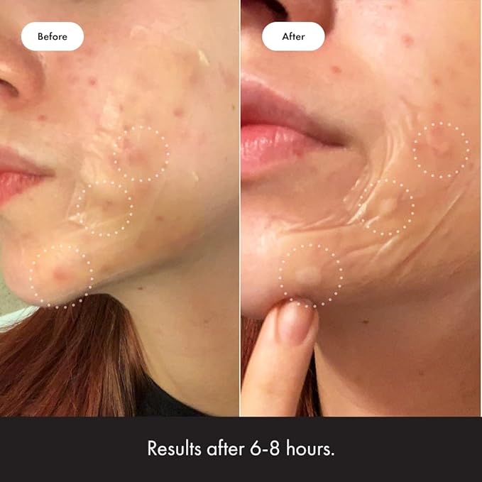 Mighty Patch Surface Large Pimple Patches for Face from Hero Cosmetics, Acne Spot for Body, Cheek, Forehead, and Chin, Pimple Stickers, Hydrocolloid Covers, Vegan-friendly, 10 Count-Velvo Beauty