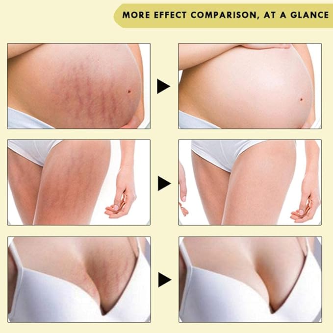 Rose Remove Stretch Marks Cream for Pregnancy Scar Removal Cream Natural Plant Essence Formula Prevention Remove Stretch Mark Old Scars Body Moisturizer 40g-Velvo Beauty