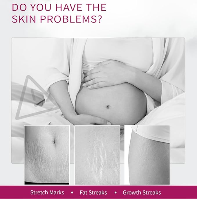 Stretch Mark Removal Cream, Obesity Stretch Mark Moisturizer, Postpartum Repair Stretch Mark Cream, Abdominal Stretch Mark Cream, Remove Marks (2 PCS)-Velvo Beauty