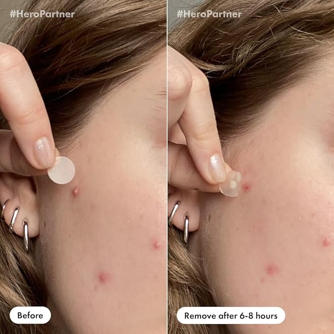 Mighty Patch™ Day and Night Patches – The Hydrocolloid Patch Duo Pack. Derm-Tested. Medical-Grade Hydrocolloid. Absorbs Pimple Gunk in 6-8 Hours. 36ct (18x Original, 18x Invisible+)-Velvo Beauty