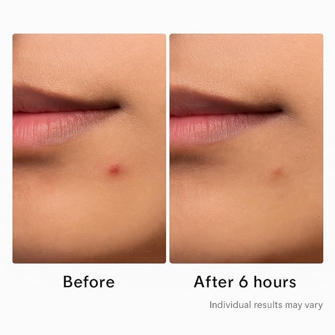 Hydrocolloid Acne Pimple Patch – 72 Count (9mm & 12mm) | Invisible Spot Patches for Pimples, Zits, Blemishes & Whiteheads | Fast Healing, Waterproof, Strong Adhesion & Gentle on Skin-Velvo Beauty