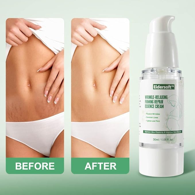 Wrinkle-Relaxing Firming Repair Essence Cream - Removes Maternity Stretch Marks, Prevents Wrinkles & Fine Lines, Nourishes & Rejuvenates Skin with Safe, Natural Formula-Velvo Beauty