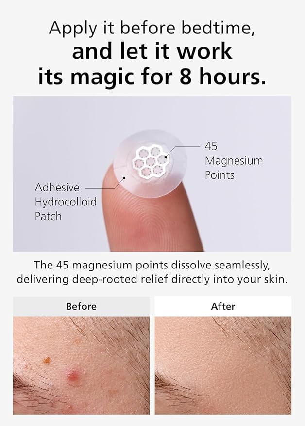 EasyDerm Magnesium Pimple Patches – Hydrocolloid Acne Spot Treatment with Ampoule & Tweezer, 10 Calming Zit Stickers by Daewoong, 이지덤, 대웅제약-Velvo Beauty