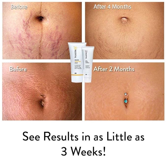TriLASTIN-SR Intensive Stretch Mark Cream Bundle with Hydro-Thermal Accelerator (5.5 & 3 oz) | Fast-Acting Stretch Marks Cream with Absorption Enhancing Serum | Hypoallergenic & Paraben-free-Velvo Beauty