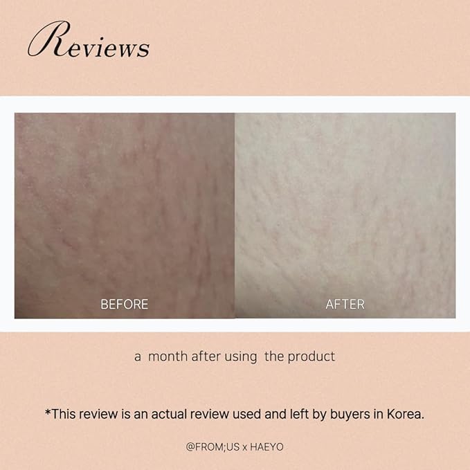 [Antley] Stretch Care Cream | Antley Ointment Gel-type | Medical Device Effective for Pregnant Dieters Adolescents (Gel Type), White-Velvo Beauty