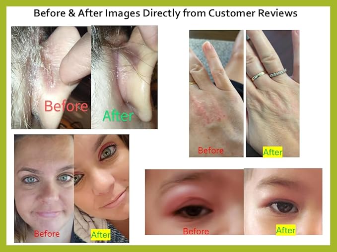 Tea Tree Oil Balm -100% All Natural | Great Cream for Soothing Irritations like Rashes, Insect Bites, Folliculitis, Acne, Itches, Dry Heels, Cuticles, Saddle Sores and more!-Velvo Beauty