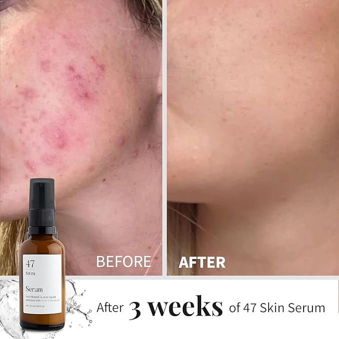 Hydrating Face Serum for Clearing Acne and Scars, Anti-Blemish & Scar Repair Serum Skincare Treatment with Silver Chitoderm Smooth Skin Moisturiser Serum for All Skin Types (1.69 oz)-Velvo Beauty