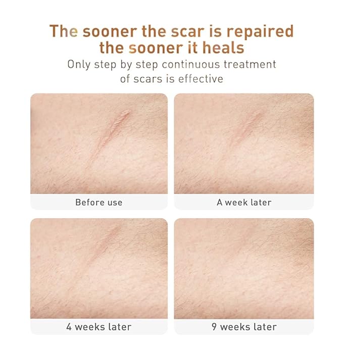Acne Scar Removal Cream Stretch Marks Face Skin Cream Shrink Pores Gel-Fade Scar Marks Acne Skin Care (Packaging Upgrade) VeniCare-Velvo Beauty