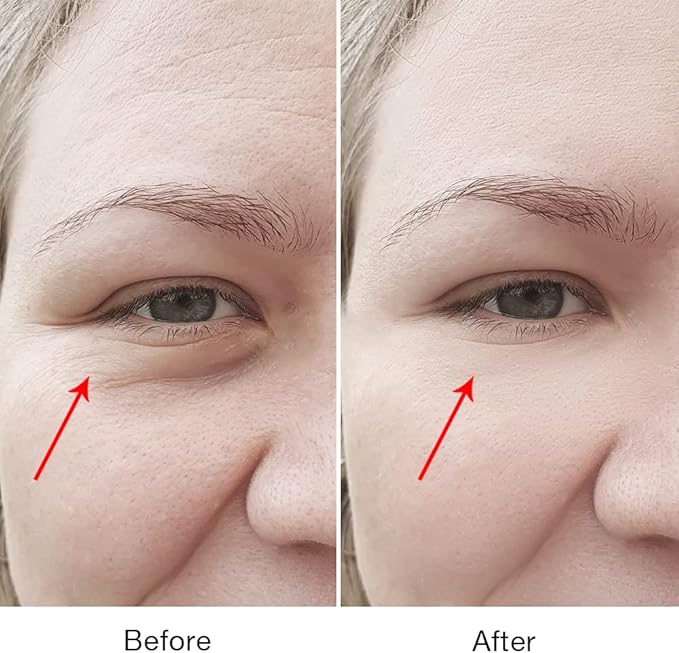 Puffy Eyes Treatment | Eye Puffiness | Eye Bags | Crows Feet | Fine Line Reducing - TS-Lifter Technology(Minor Stings) + Radio Frequency - 2 in 1 Professional RF Eye Anti Aging Device-Velvo Beauty