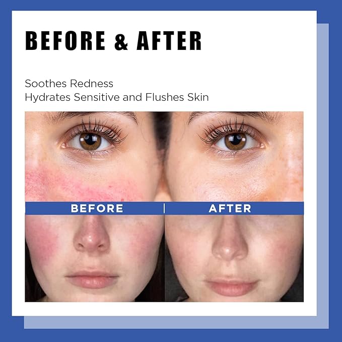 It'S SKIN LI Calming Skincare Set - Soothing Toner Pads, Ampoule Serum, Moisture Cream – Redness & Acne Relief with Licorice Extract & Guaiazulene – for Clear Skin-Velvo Beauty