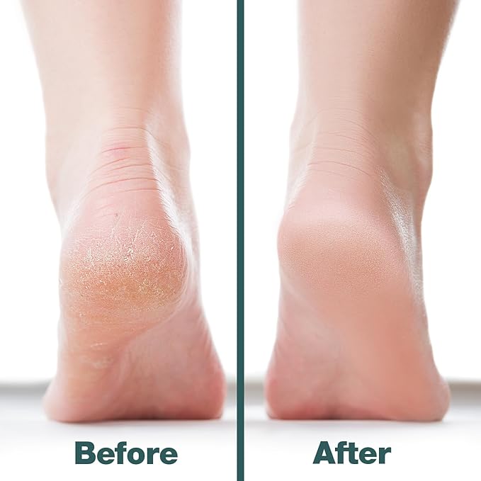 Probelle Double Sided Multidirectional Nickel Foot File Callus Remover - Immediately Reduces calluses and Corns to Powder for Instant Results, Safe Tool (White)-Velvo Beauty