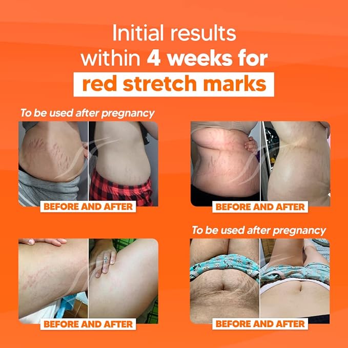 Cicatrissim Deep Stretch Mark Removal Cream - Innovative Formula With Pure and Powerful Natural Ingredients From Brazilian Flora - For All Stretch Marks & Skin Types.-Velvo Beauty