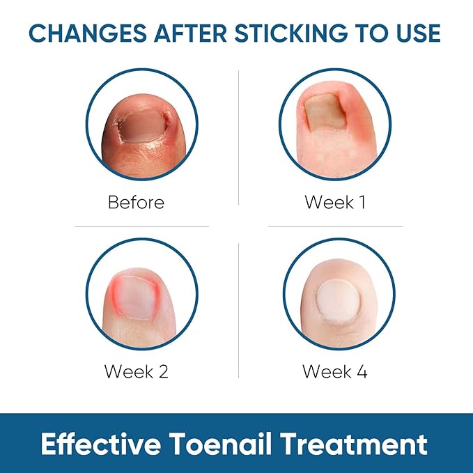 Ingrown Toenail Treatment, 60Pcs Ingrown Toenail Corrector Strips, Ingrown Toenail Removal Kit with File and Lifter, 60Pcs-Velvo Beauty