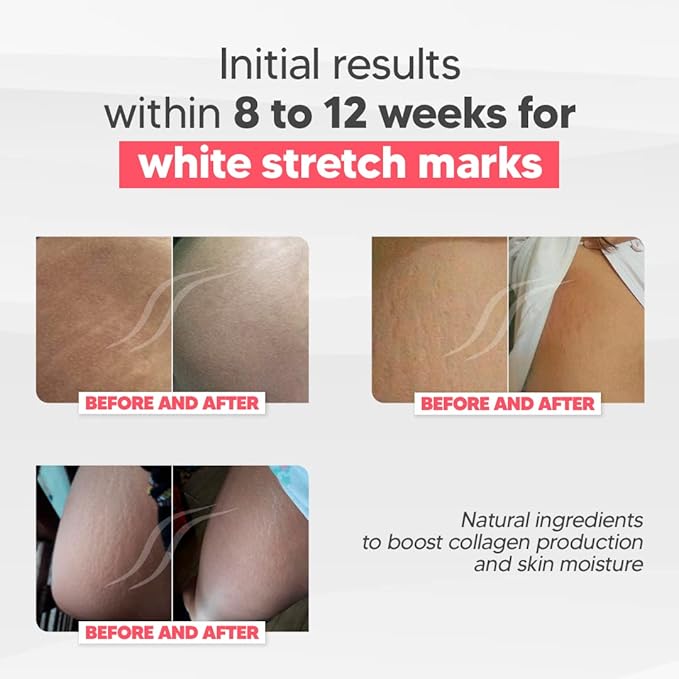 Cicatrissim White Stretch Mark Fade and Removal Cream - Innovative Formula With Pure and Powerful Natural Ingredients From Brazilian Flora - For All Skin Types.-Velvo Beauty