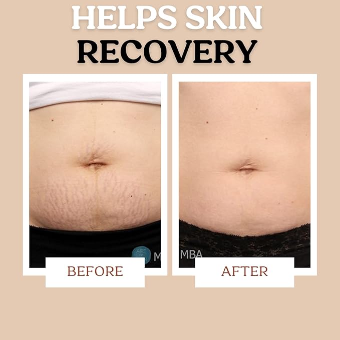 Stretch Mark Cream for Sensitive Skin Plant-Based Long and Short-term Hydration, Increases Skin Elasticity and Firmness (Stretch Mark Cream)-Velvo Beauty