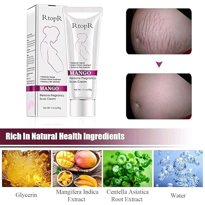 RtopR Mango Stretch Marks and Scar Cream -Stretch Marks and Scar Removal Cream for Pregnancy - Best Body Moisturizer-80g-Velvo Beauty