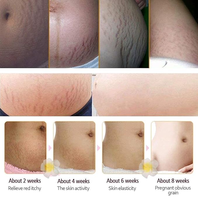 RtopR Mango Stretch Marks and Scar Cream -Stretch Marks and Scar Removal Cream for Pregnancy - Best Body Moisturizer-80g-Velvo Beauty