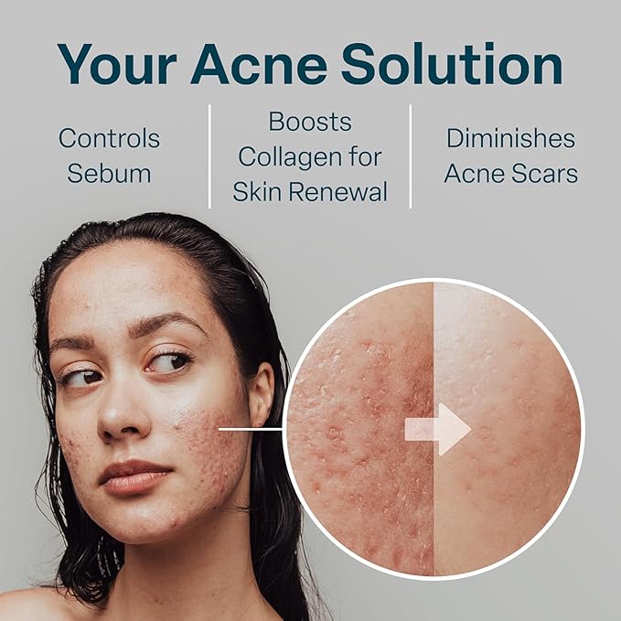 QRxLabs Glycolic/Salicylic Acid 10/2 Acne Control Pads with 10% Ultra Pure Glycolic + 2% Salicylic Acid, Allantoin, Vitamins B5, C & E, Calendula Green Tea - Most Effective Treatment Clear Skin - 2PK-Velvo Beauty