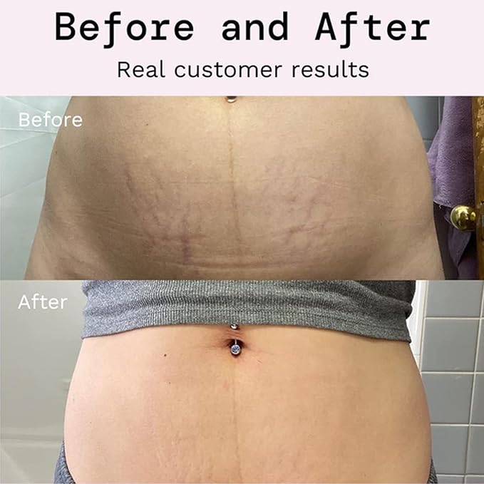 Stretch Mark Prevention Cream for Pregnancy, Stretch Mark Cream Remover, Stretch Mark Lotion for Pregnancy, Tummy Butter for Stretch Marks Pregnancy, Shea Butter Stretch Mark Removal Cream-Velvo Beauty