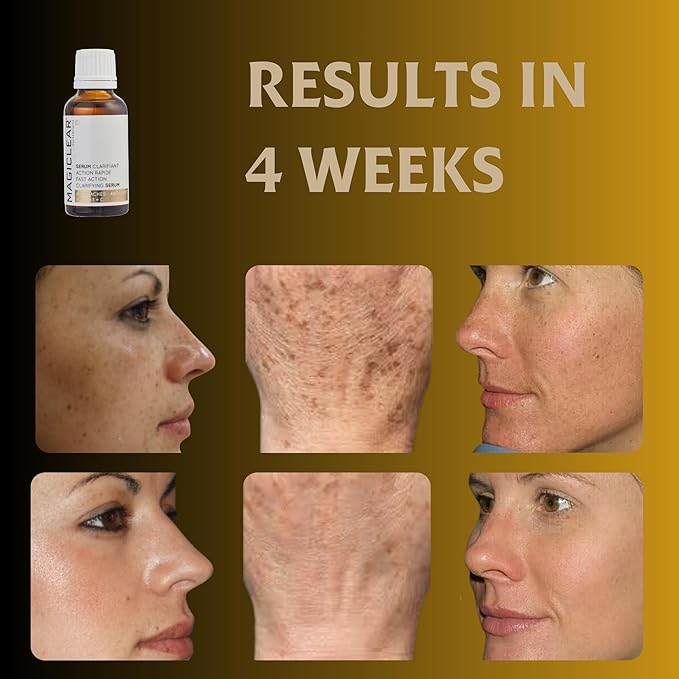 Luxury Swiss Dark Spot Remover for Face and Body Serum Gel Cream Age Sun Brown Spot Acne Freckles Corrector Melasma treatment Anti aging Skin Vitamin C + Niacinamide best organic brand Magiclear-Velvo Beauty