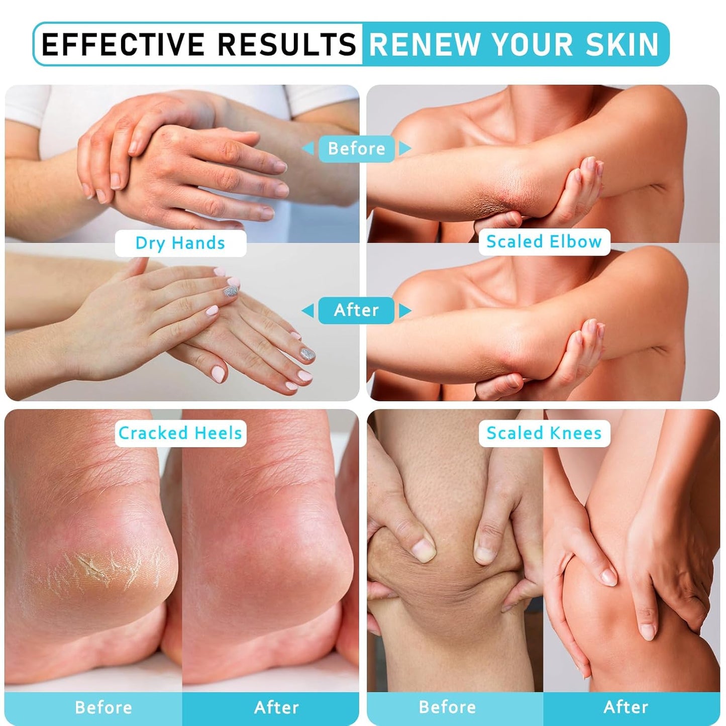 Urea Cream 40 Percent For Feet Maximum Strength - plus Salicylic Acid 2% Foot Cream For Dry Cracked Heels Feet Knees - Dead Skin Cuticle Callus Remover Toenail Softener-Velvo Beauty