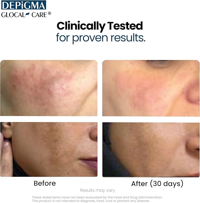 GlocalCare Depigma Support Reduction of Hyperpigmentation, Melasma & Dark Spots with Glutathione, Polypodium Leucotomos, Grape Seed & Marigold Extract-Velvo Beauty