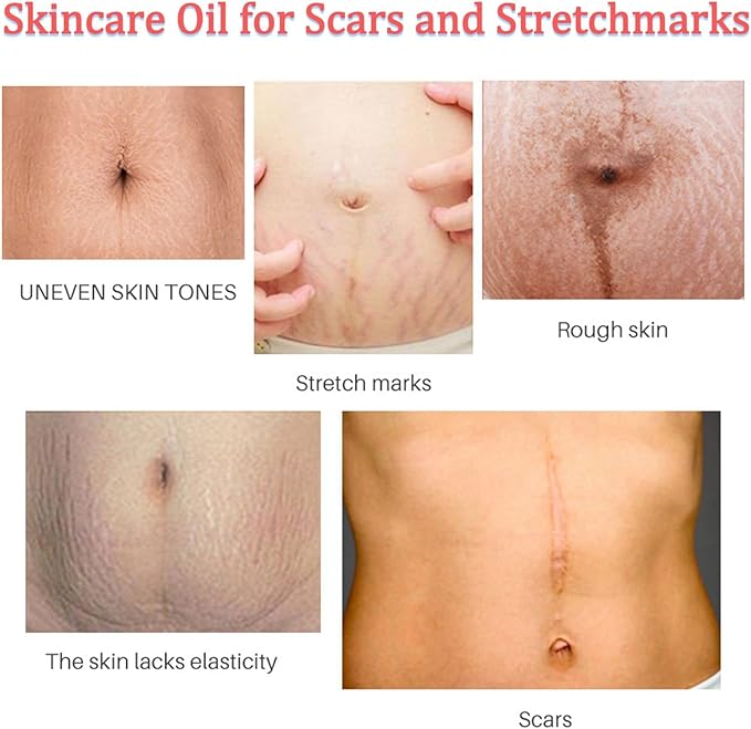 Stretch Mark Pregnancy Massage Oil, Stretch Mark Oil, Skincare Oil for Improve Stretchmarks, Pregnancy Skin Care Fade Stretch Marks, Body Moisturizer for Dry Skin, First Time Mom Gift 30 ml-Velvo Beauty