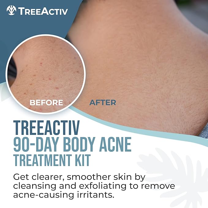 TreeActiv 90-Day Body Acne Treatment Kit, Salicylic Acid Acne Body Spray, Exfoliating Body Acne Wash, Body Acne Treatment for Back, Chest and Butt Acne Removal, Back Acne Treatment For Women and Men-Velvo Beauty