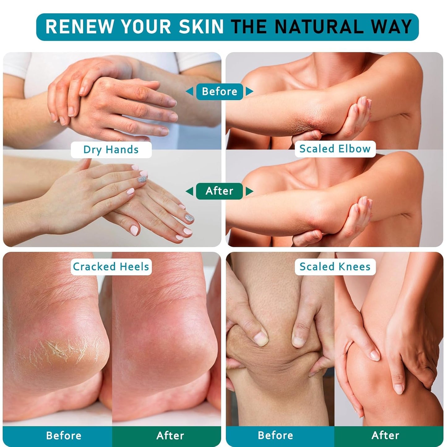 Urea Cream 40 Percent For Feet Maximum Strength - plus Salicylic Acid 2% Foot Cream For Dry Cracked Heels Feet Knees - Dead Skin Cuticle Callus Remover Toenail Softener - Pack of 2-Velvo Beauty