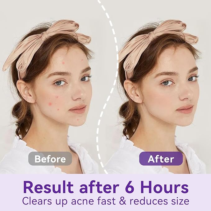 Overnight Pimple Patches for Face - Maximum Strength Hydrocolloid for Cystic Acne & Dark Spots (72 Count) - 10mm & 12mm Medicated Night Time Treatment-Velvo Beauty