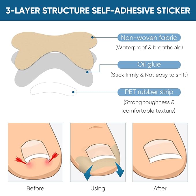 Ingrown Toenail Treatment, 60Pcs Ingrown Toenail Corrector Strips, Ingrown Toenail Removal Kit with File and Lifter, 60Pcs-Velvo Beauty