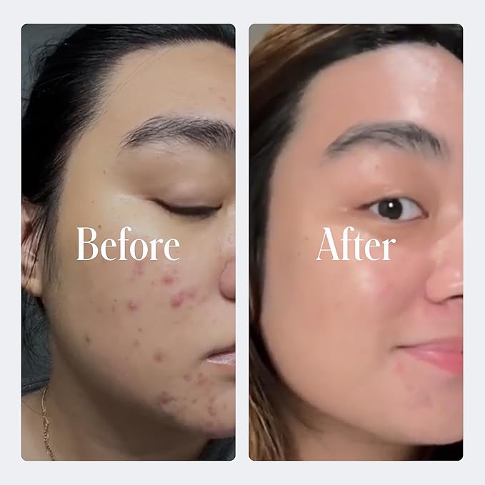Geologie Clear System | 3-Step Acne Treatment & Skincare Set | Clears Skin Fast | Acne Gel Cleanser, SPF15 Day Cream & Retinol Face Cream For Men & Women | Month 1 / Level 1-Velvo Beauty