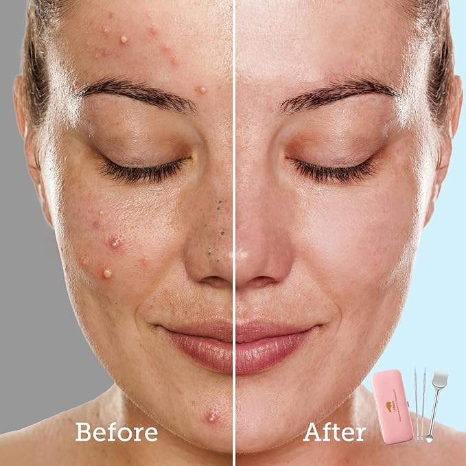 LitBear Pore Prep Tool, Blackhead Remover Pimple Popper Tool Kit, Stainless Steel Blackhead Extractions Tool for Acne, Whitehead Popping, Blemish, Comedone, Pink-Velvo Beauty